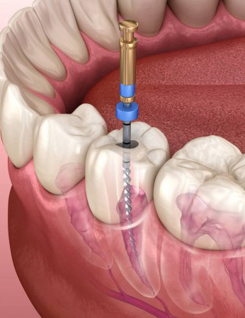 depositphotos_308129356-stock-photo-endodontic-root-canal-treatment-process copia