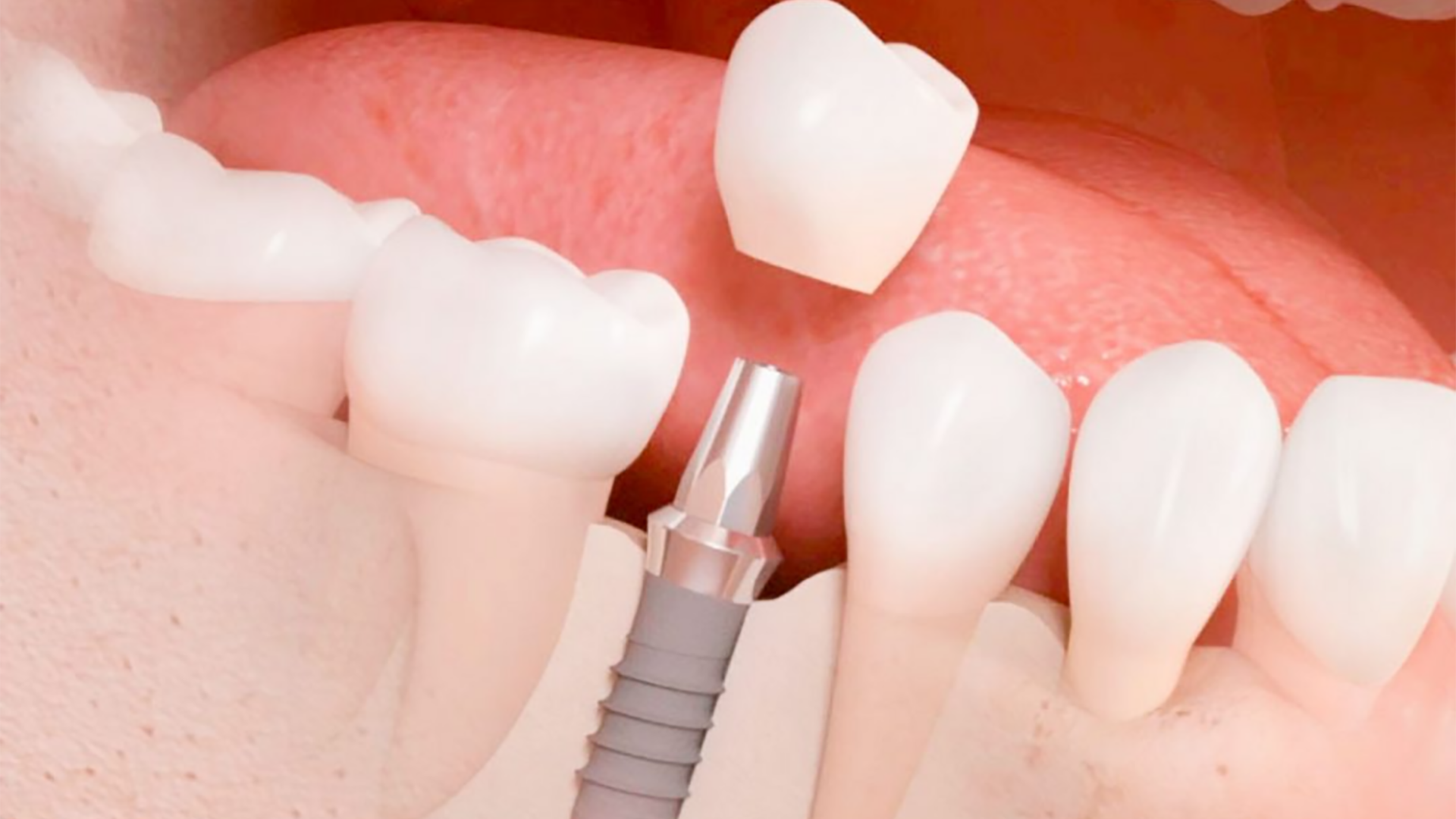 implantes-dentales copia