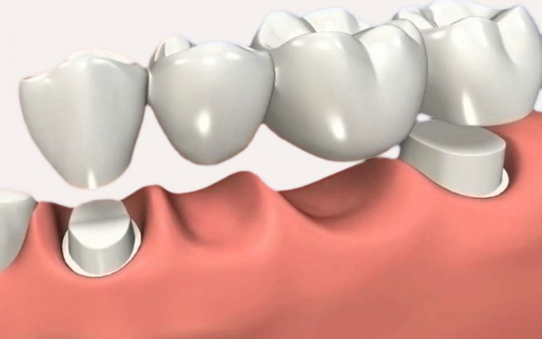 puentes-y-coronas-dentales-1080x675